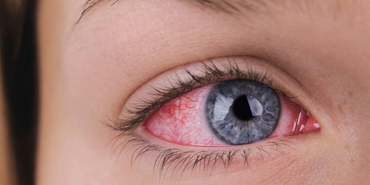 Eye Allergy Treatment Market Trends, Size, Segments, Industry Growth and Forecast to 2030